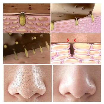BREYLEE Hudorm Remover Sort Maske hudpleje Anti Acne Behandling Peel Off ansigtsmaske Pore Refining Serum Krymper Pore Kit