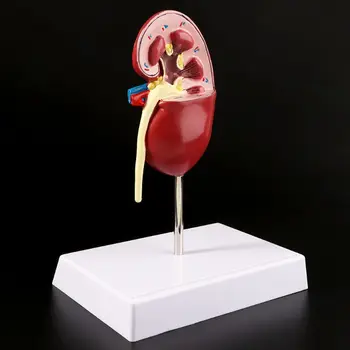 Nyre-Syge Model Anatomiske Anatomi Syge Patologiske Sten Orgel Undervisning Forsyninger L29K