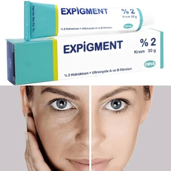 Expigment 30g 1 ounce Hydroquinon Creme 2% Til Hud-Blegning af Huden Lysere Hud Kridtning Melasma Anti-blemish