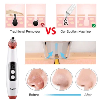 Hudorm Remover vakuumsug med Kamera Visuelle Pore Renere Ansigt Dyb Næse Cleasning Acne Bums Fjernelse Emhætte Skønhed